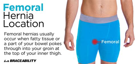 Abdominal Strain Vs Hernia Escompendium