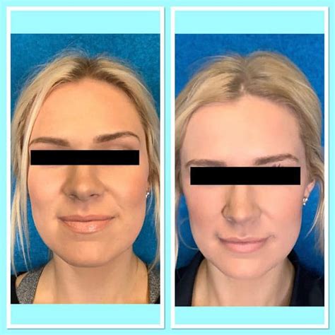 Botox For Jawline Slimming Renew Md Facial Aesthetics