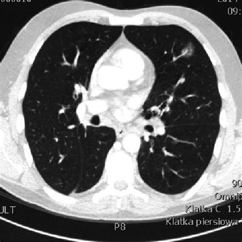 Pdf Primary Pulmonary Malt Lymphoma Case Report And Literature Overview