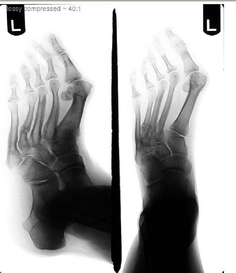 Figure 7 From Treatment Of Fourth Metatarsal Base Fracture Non Unions