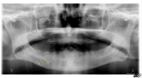 Case of the Week: Sialolith - Dr. G's Toothpix