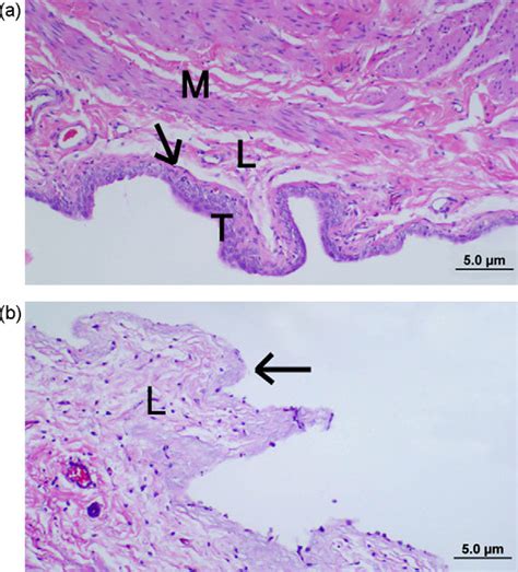 Selective Harvest Of The Urinary Bladder Transitional Epithelium By