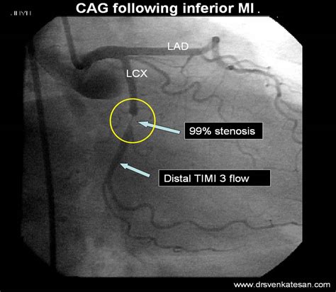 Coronary angiogram. Causes, symptoms, treatment Coronary angiogram