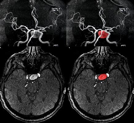 A brain aneurysm, also known as a subarachnoid hemorrhage (sah), is a weak spot in the wall of a blood vessel inside the brain. Foto de Artéria Cerebral Aneurisma Ressonância Magnética e ...