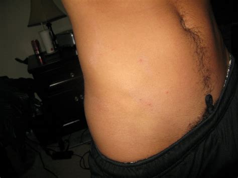 Stds · 9 years ago. What bumps are appearing on my skin?