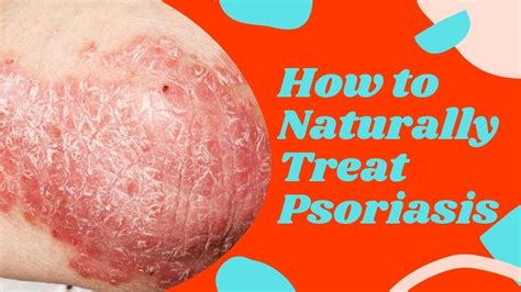 How To Treat Psoriasis Naturally Best Home Remedies For Psoriasis Natural Cures System Youtube