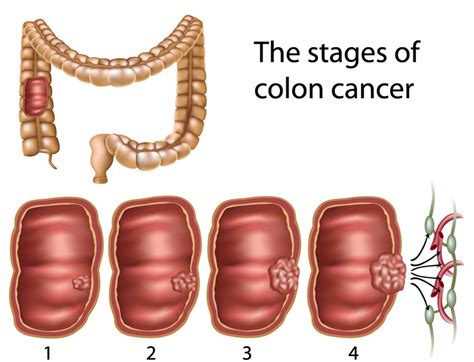 It is sometimes used with a dash after it. Prevention of Colon Polyps and Cancer : GiCare.com