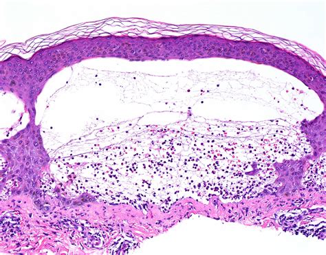 Pathology Outlines Dermatitis Herpetiformis