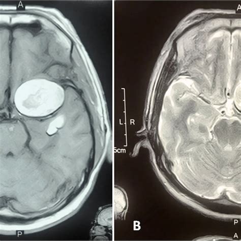 Pdf Recurrence Of Ruptured Intracranial Epidermoid Cyst A Rare Case