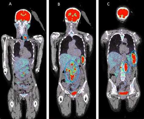 An Overview About Pet Ct Scans In A Nutshell Przespider