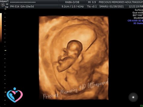 Pregnancy Ultrasound Image Gallery 10 16 Weeks