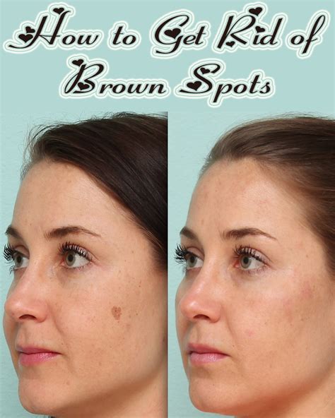 How To Get Rid Of Brown Spots Healthy Sip