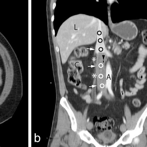 Contrast Enhanced Ct Scan Of The Abdomen Showing Small Bowel