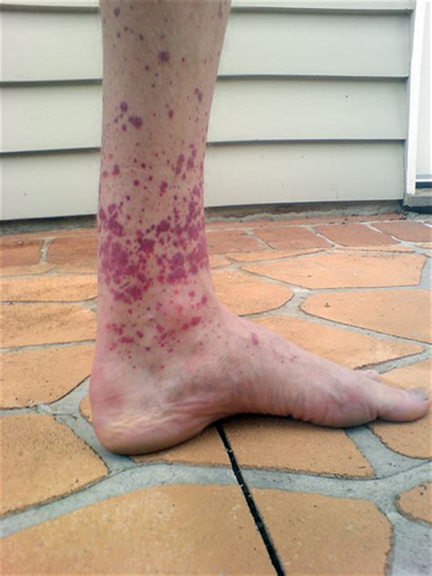 Henoch Schonlein Purpura Causes Symptoms Diagnoses Pictures