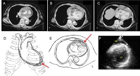 Cardiac Tamponade Due To Aortic Dissection Clinical Picture And