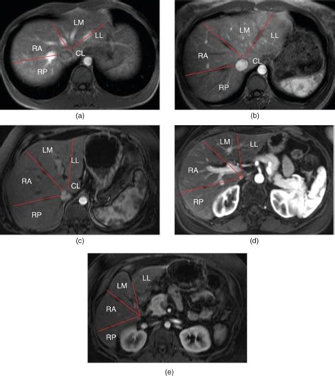 The Cross Sectional Anatomy Of The Liver And Normal Variations