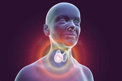 Thyroid Cancer In Women Illustration Showing Tumor Inside Thyroid