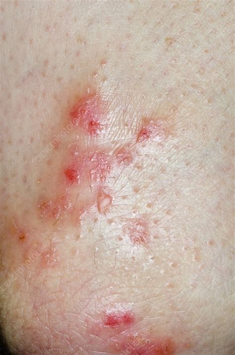 Eczema On The Elbow Stock Image C0169218 Science Photo Library