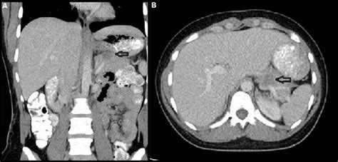 Cureus Solid Pseudopapillary Tumor Of The Pancreas An Unusual Cause