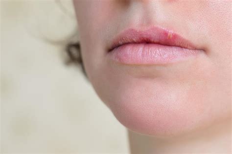 Bump On Lip Causes Treatment And When To See A Doctor