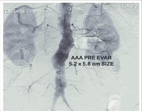 Aaa Seen On Angiogram During Evar Procedure Prior To Placement Of Y