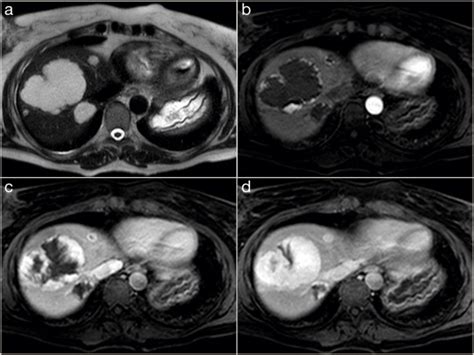 Benign Liver Lesions Surgery Oxford International Edition