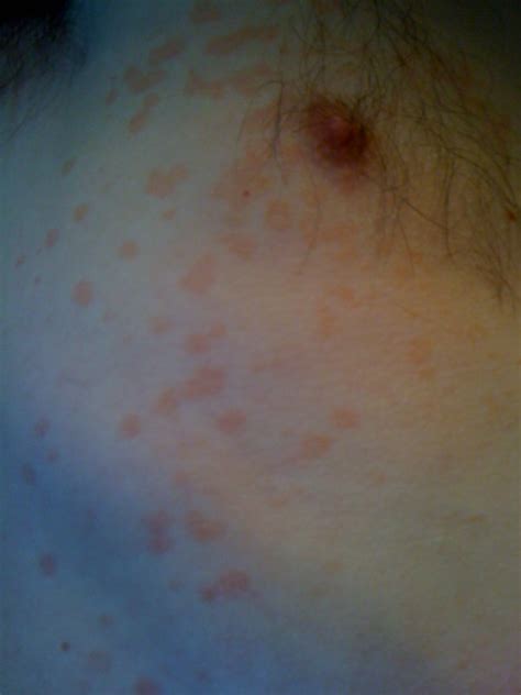 I Have Red Scaly Spots All Over My Chest I Think It May Be