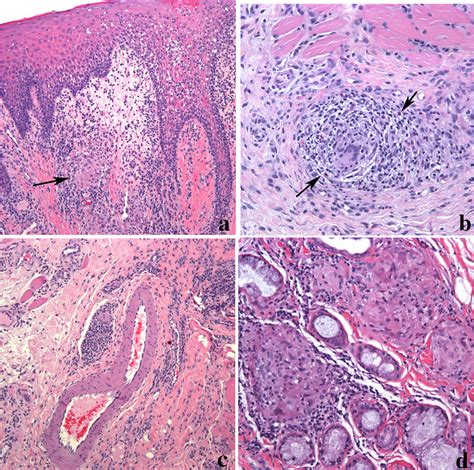 Orofacial Granulomatous In A Lip Biopsy A Epithelial Hyperplasia With Download Scientific