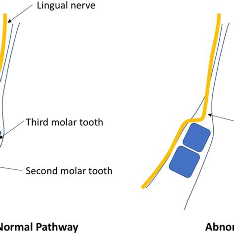 Retromolar Pad White Line Corresponding To The Retromolar Gland