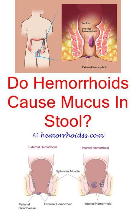 Blood In Stool Caused By Hemorrhoids