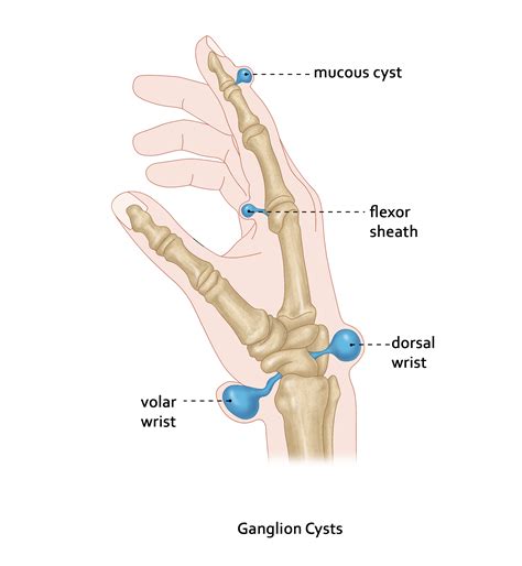 Ganglion Cyst Hand Surgery Randwick Plastic Surgery
