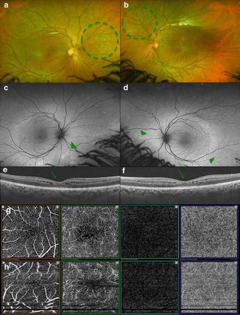 Color Fundus Photographs Of The Posterior Pole And The Mid Periphery Of