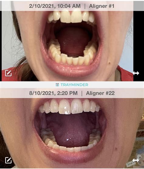 Today Marks 6 Months With Invisalign Invisalign