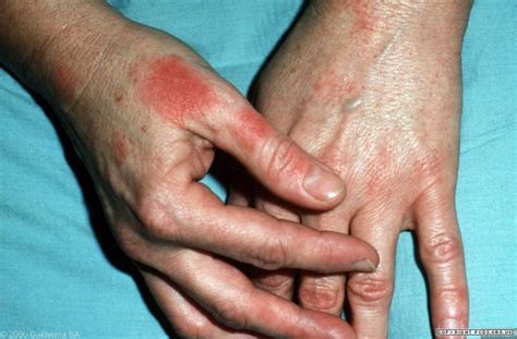 Latex Glove Allergy Symptoms Images Gloves And Descriptions