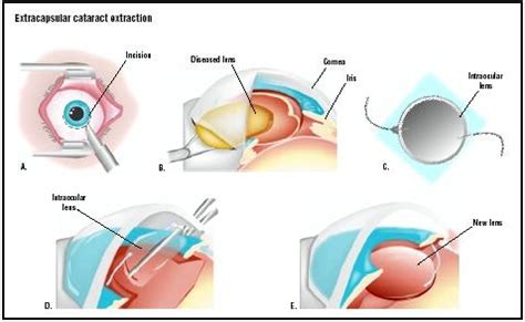 What types of doctors perform cataract surgery? Extracapsular Cataract Extraction - procedure, recovery ...