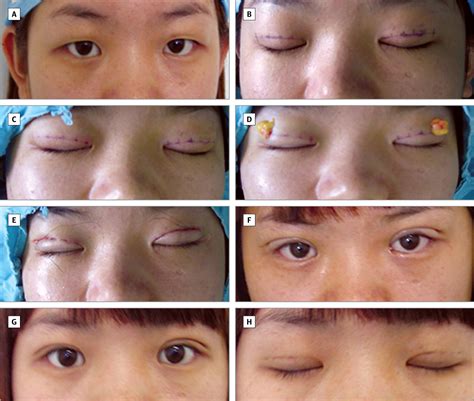 Creating Natural Double Eyelids With Continuous Buried Suture And Mini