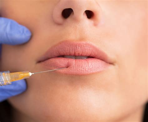 What Are Lip Fillers And Are They Worth It