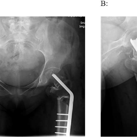 Hip X Rays Before The First Surgery In A Anteroposterior And B