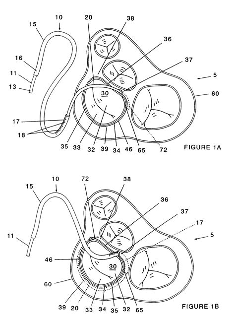 Patent Us6250308 Mitral Valve Annuloplasty Ring And Method Of