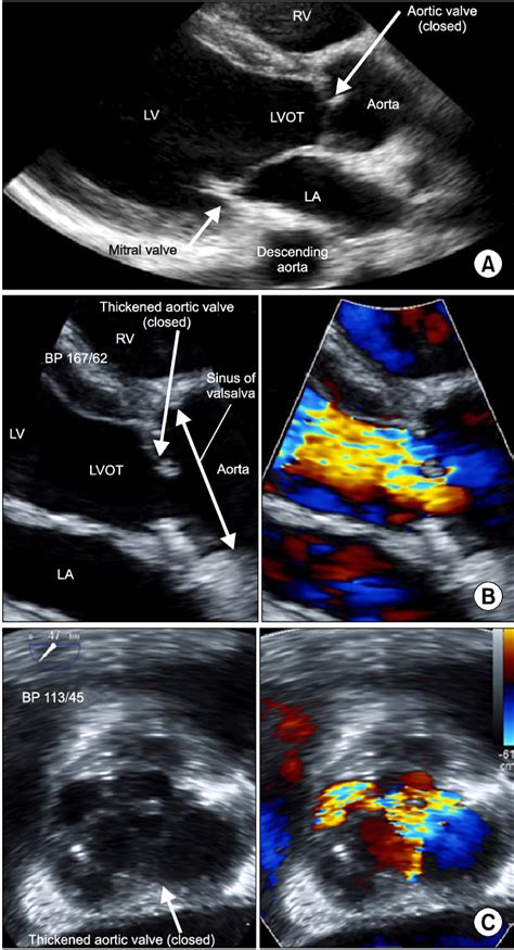 Transthoracic Echocardiographic Images A Parasternal Long Axis View