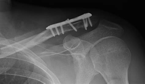 Clavicle Fractures Midshaft Trauma Orthobullets