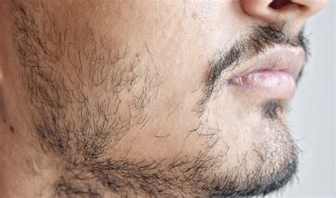 What Causes A Patchy Beard