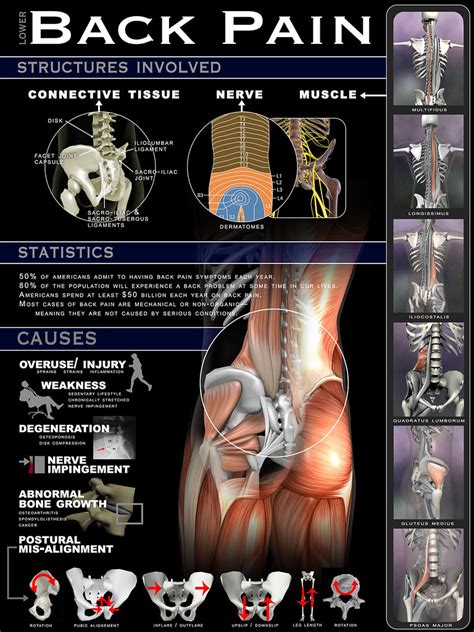 Lower Back Pain Infographic Infographic By Realbodywor Flickr