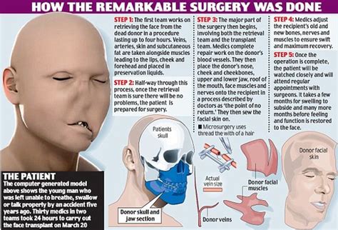 【閲覧注意】顔が石切断機でぐちゃぐちゃからの顔面移植手術。現代の医療技術は素晴らしい！｜アプリ学園