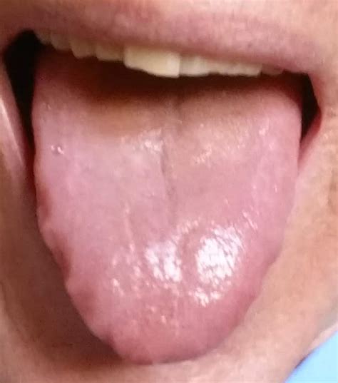 Tongue Diagnosis For Quick Self Diagnosis Acupuncture Points