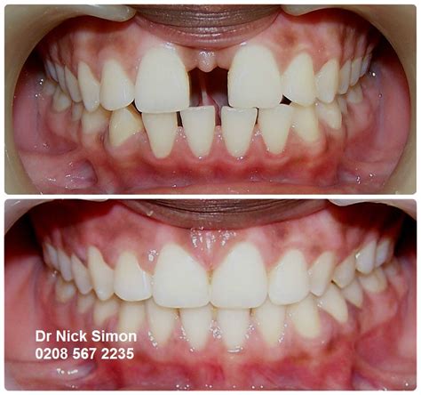 Closing Gaps With Dental Braces Dr Nick Simons Six Month Smiles Blog