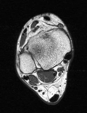 You can divide the foot muscles into groups based on their locations — either in the sole of the foot (the bottom or plantar area) or the dorsum they don't work as intricately as the small muscles in the hands; ArUn's MRI Protocols: ANKLE MRI IMAGING PLANES