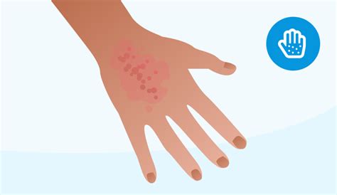 Dermatite Da Contatto Sintomi E Cause Doctolib