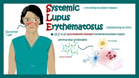 Systemic Lupus Erythematosus Signs And Symptoms Pathophysiology And