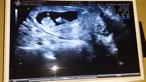 Ultrasound 10 Weeks 5 Days Baby Moving A Lot Youtube